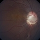 Optic Disc Coloboma Optic Disc Coloboma