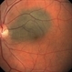 Choroidal Nevus Choroidal Nevus