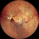 VITREOUS HEMORRHAGE WITH 360 DEGREE LASER PRP: RE VITREOUS HEMORRHAGE WITH 360 DEGREE LASER PRP: RE