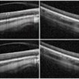 Spontaneous Resolution of Vitreomacular Traction