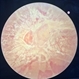Tractional Retinal Detachment Tractional Retinal Detachment