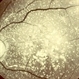 Primary Hyperoxaluria and Oxalosis