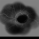 Primary Subhyaloid Hemorrhage Due to Valsalva Retinopathy