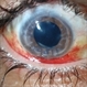 Ruptured Globe Trauma