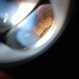 Ciliary Body Melanoma