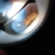 Ciliary Body Melanoma