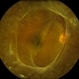 Fibrosis Traction
