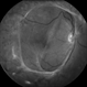 Fibrosis Traction