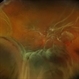 Idiopathic Uveal Effusion Syndrome with Diabetic TRD Idiopathic Uveal Effusion Syndrome with Diabetic TRD