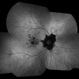 Cystoid Macular Edema