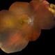 Cystoid Macular Edema