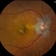 Cystoid Macular Edema