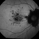 Cystoid Macular Edema