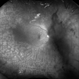 Proliferative diabetic retinopathy Proliferative diabetic retinopathy