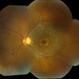 Bull' s Eye Maculopathy Without Plaquinel
