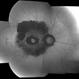 Bull' s Eye Maculopathy Without Plaquinel