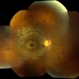 Bull's Eye Maculopathy Without Plaquinel