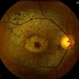 Bull's Eye Maculopathy Without Plaquinel