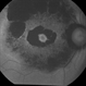 Bull's Eye Maculopathy Without Plaquinel
