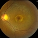 Bull's Eye Maculopathy Without Plaquinel