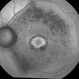 Bull's Eye Maculopathy Without Plaquinel