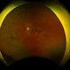 Proliferative Diabetic Retinopathy Proliferative Diabetic Retinopathy