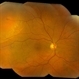 Retinal Detachment with Retinal Hole
