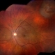 Horseshoe Tear With Scleral Buckle