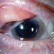 Conjunctival Tumor