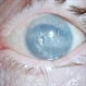 Band Keratopathy/Neurotrophic Ulcer