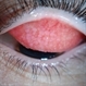 Giant Papillary Conjunctivitis