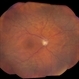 Choroidal Thickening