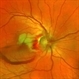 Partial Optic Disc Avulsion with Optic Disc Pit Partial Optic Disc Avulsion with Optic Disc Pit