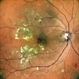 CIRCINATE RETINOPATHY CIRCINATE RETINOPATHY