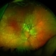 Hypertensive Retinopathy, Right Hypertensive Retinopathy, Right