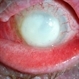 Endophthalmitis