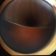 Ciliochoroidal Melanoma Ciliochoroidal Melanoma