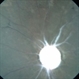 Optic atrophy Optic atrophy