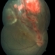 Retinal Capillary Hemangioblastoma Retinal Capillary Hemangioblastoma