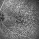 Pentosan Maculopathy Fluorescein Angiogram Left