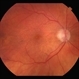 Reticular Drusen Reticular Drusen