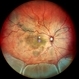 Vogt-Koyanagi-Harada with Exudative Retinal Detachment Vogt-Koyanagi-Harada with Exudative Retinal Detachment