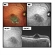 Cystoid Macular Edema Multicolor imaging Cystoid Macular Edema Multicolor imaging