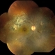 Lupus Retinopathy