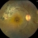 Lupus Retinopathy