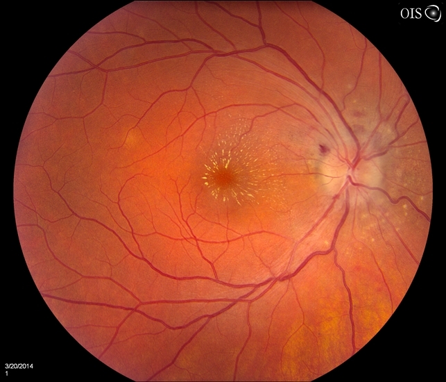 Bilateral Macular Star - Retina Image Bank