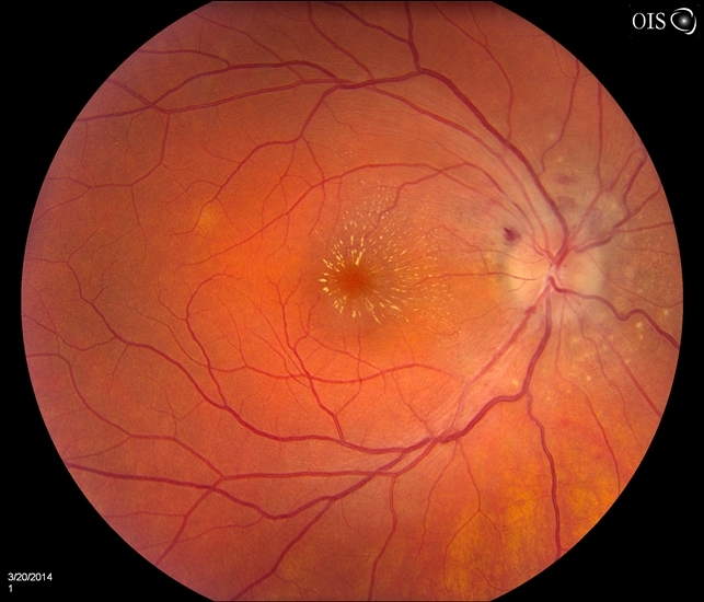 Bilateral Macular Star Retina Image Bank