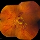 Diabetic Retinopathy