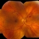Diabetic Retinopathy