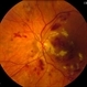 Diabetic Retinopathy